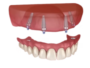 Denture Clinic Services